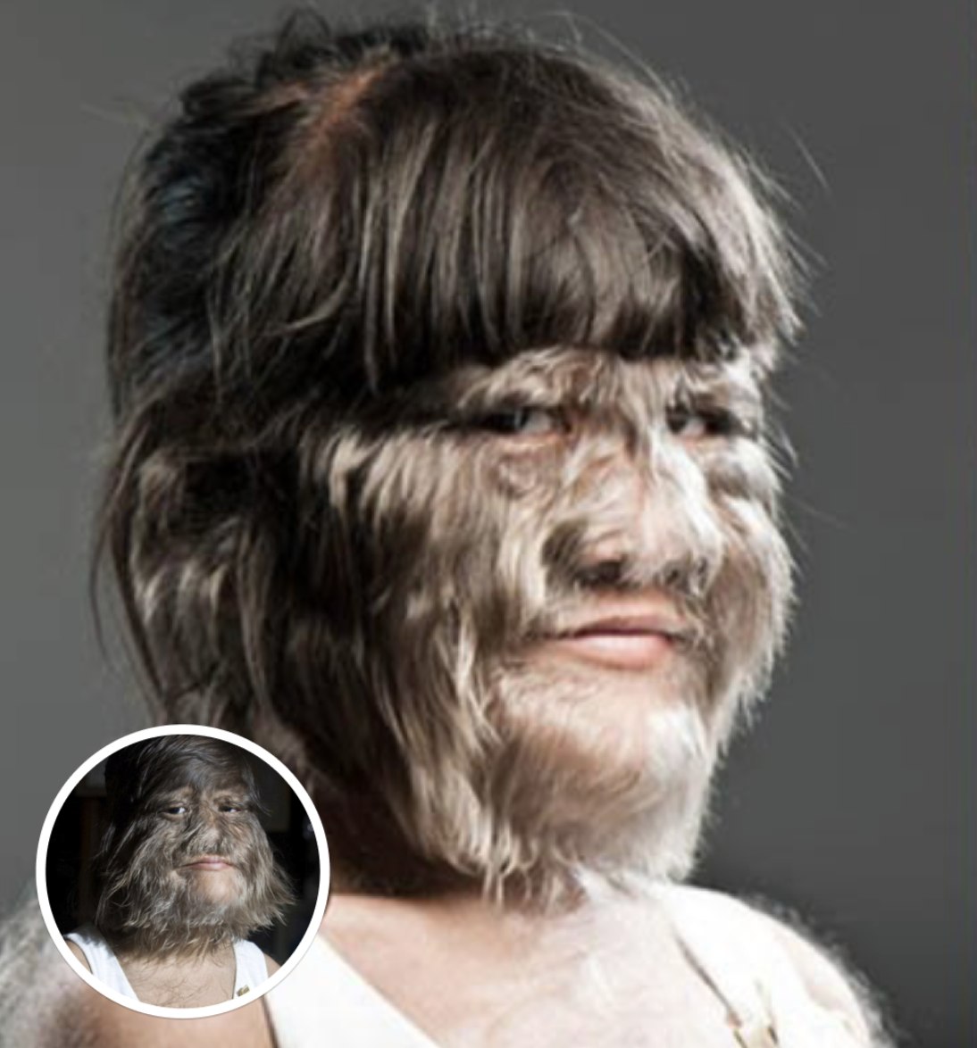 World’s ‘Hairiest Girl’ Shaves It All Off After Meeting Her Soulmate, Here’s How She Looks After